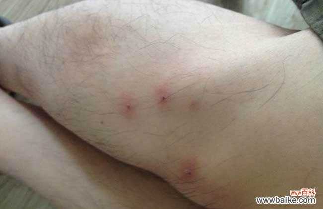 怎么判断是不是跳蚤咬的包 跳蚤咬了有什么症状?