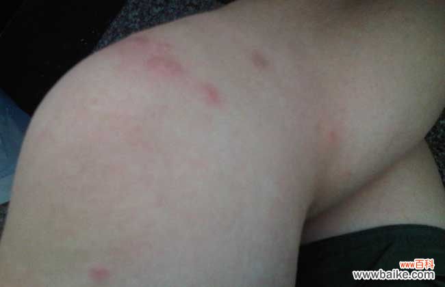 怎么判断是不是跳蚤咬的包 跳蚤咬了有什么症状?