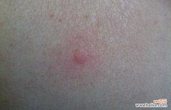 怎么判断是不是跳蚤咬的包 跳蚤咬了有什么症状？