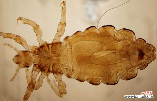 头上有虱子怎么治最快 头上长虱子怎么办?