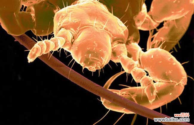 头上有虱子怎么治最快 头上长虱子怎么办?